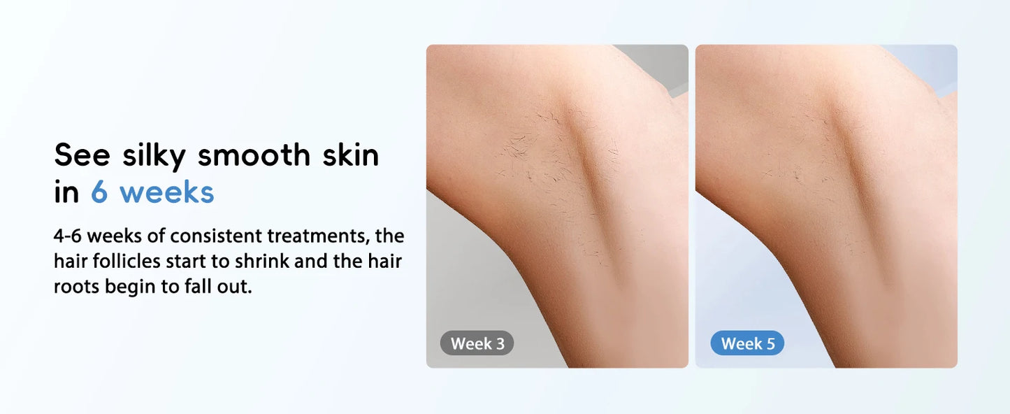 IPL Laser Hair Removal – 22J, Unlimited Flashes, 5.2cm² Window