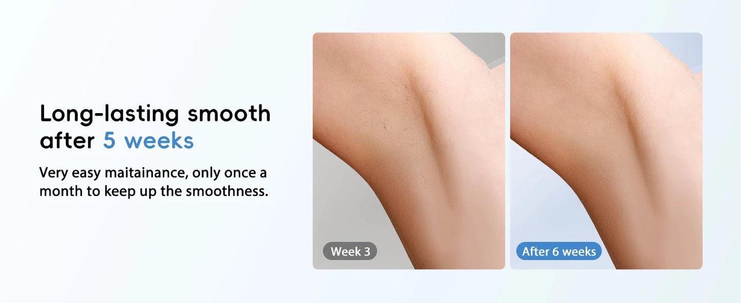 IPL Laser Hair Removal – 22J, Unlimited Flashes, 5.2cm² Window